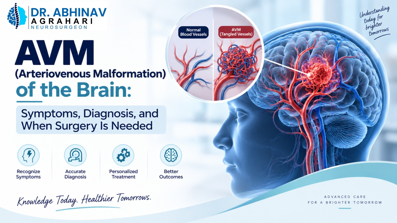 AVM (Arteriovenous Malformation) of the Brain: Symptoms, Diagnosis, and When Surgery Is Needed